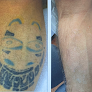 Houston Tattoo Removal Clinic Laser Tattoo Removal