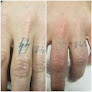 Htown Lasers Laser Tattoo Removal