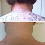 Idealaser Cosmetic Center Of Miami Laser Tattoo Removal
