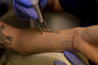 Ink Blasters Precision Laser Tattoo Removal Laser Tattoo Removal
