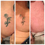 Ink Rewind Laser Tattoo Removal