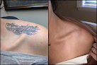 Inkaway Laser Tattoo Removal - Tattoo Removal In Chadds Ford, Pa Laser Tattoo Removal