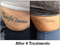 Inkaway Laser Tattoo Removal Laser Tattoo Removal