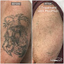 Inkfree, Md Laser Clinic Laser Tattoo Removal