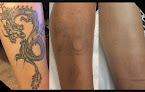 Inkless Tattoo Removal Laser Tattoo Removal