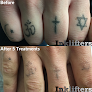 Inklifters Tattoo Removal Laser Tattoo Removal