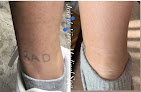 Jdv Med Spa Laser Tattoo Removal