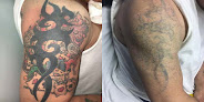 Jiva Med Spa Columbus Laser Tattoo Removal