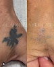 Ladru / Ink By Lacey / Microblading / Pico Laser Tattoo Removal Laser Tattoo Removal