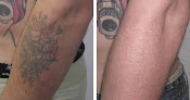 Laguna Laser Hair And Tattoo Removal Laser Tattoo Removal