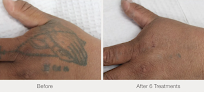 Laser Eraser: Laser Tattoo Removal Laser Tattoo Removal