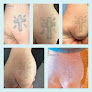Laser180 Laser Tattoo Removal
