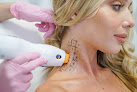 Laseraway Ashburn Laser Tattoo Removal