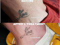 Laserfied Tattoo Removal Milwaukee, Wi Laser Tattoo Removal