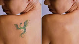 Limelight Laser & Medical Spa Laser Tattoo Removal