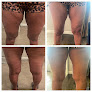 Love Your Skin & More Laser Tattoo Removal