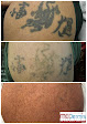 Medermis Tattoo Removal Laser Tattoo Removal