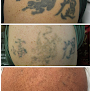 Medermis Tattoo Removal Laser Tattoo Removal