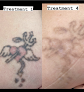 Medical Aesthetics Of Suwanee Laser Tattoo Removal