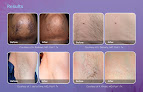 Midland Light Touch Laser Laser Tattoo Removal