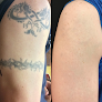 Milwaukee Laser & Body Aesthetics Laser Tattoo Removal