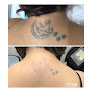 Miss Laser - Laser Hair Removal, Tattoo Removal & Body Contouring Laser Tattoo Removal