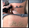 My Laser And Beauty Laser Tattoo Removal