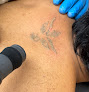 Neo Tattoo Removal & Fading Laser Tattoo Removal