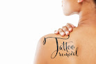 Neopulse Laser Therapy Laser Tattoo Removal