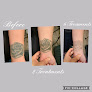 New Skin Tattoo Removal Concord Laser Tattoo Removal