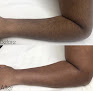 Par Laser Laser Tattoo Removal