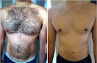 Perfectly Bare Laser Laser Tattoo Removal