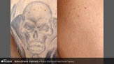 Phoenix Tattoo Removal And Skin Revitalization Laser Tattoo Removal