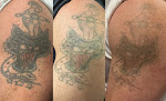Pommier Med Spa Laser Tattoo Removal