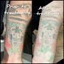 Precision Laser Tattoo Removal Laser Tattoo Removal