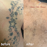 Premier Tattoo Removal Laser Tattoo Removal