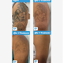 Premium Tattoo Removal Laser Tattoo Removal