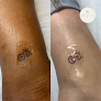 Pretty Permanent Llc Laser Tattoo Removal