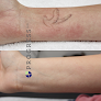 Progress Md Tattoo Removal Laser Tattoo Removal