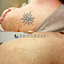 Progress Md Laser Tattoo Removal