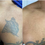 Regenerate Laser Medspa Laser Tattoo Removal