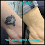 Removery Tattoo Removal & Fading Laser Tattoo Removal