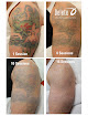 Removery Tattoo Removal & Fading Laser Tattoo Removal
