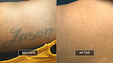 Removery Tattoo Removal & Fading Laser Tattoo Removal