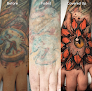 Removery Tattoo Removal & Fading Laser Tattoo Removal
