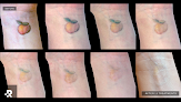 Removery Tattoo Removal & Fading Laser Tattoo Removal