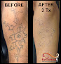 Removery Tattoo Removal & Fading Laser Tattoo Removal