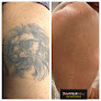 Removery Tattoo Removal & Fading Laser Tattoo Removal