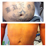 Removery Tattoo Removal & Fading Laser Tattoo Removal