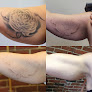 Removery Tattoo Removal & Fading Laser Tattoo Removal